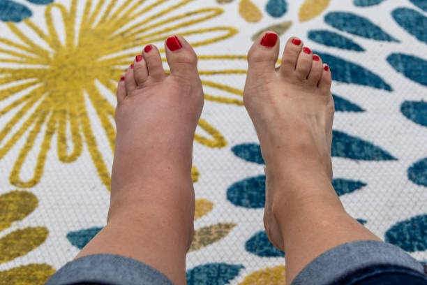 Shoes to wear with swollen foot, How to relieve foot pain after wearing heels?